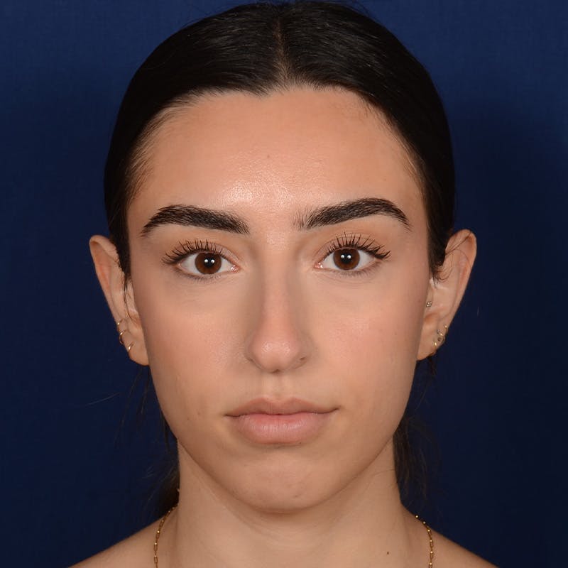 Female Rhinoplasty Before & After Gallery - Patient 367088 - Image 1