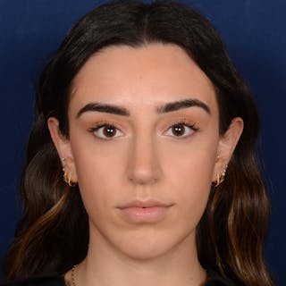 Female Rhinoplasty Before & After Gallery - Patient 367088 - Image 2