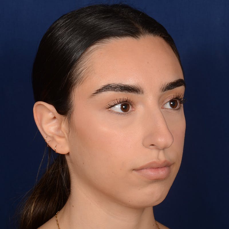 Female Rhinoplasty Before & After Gallery - Patient 367088 - Image 3