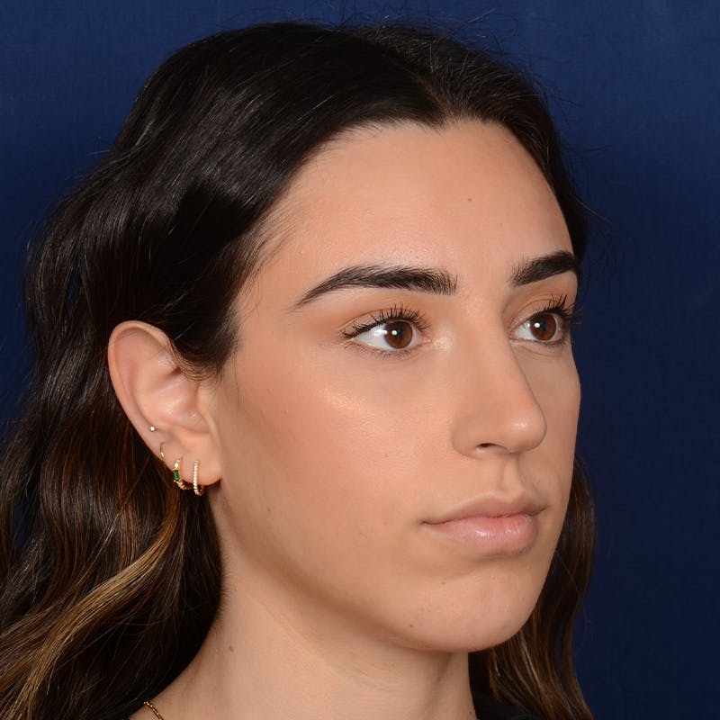 Female Rhinoplasty Before & After Gallery - Patient 367088 - Image 4
