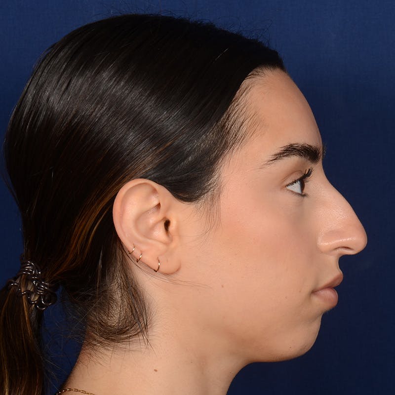 Female Rhinoplasty Before & After Gallery - Patient 367088 - Image 5