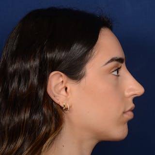 Female Rhinoplasty Before & After Gallery - Patient 367088 - Image 6