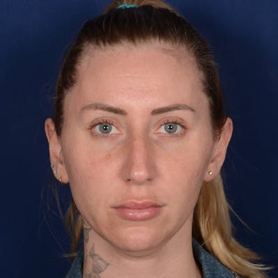 Female Rhinoplasty Before & After Gallery - Patient 198062 - Image 1