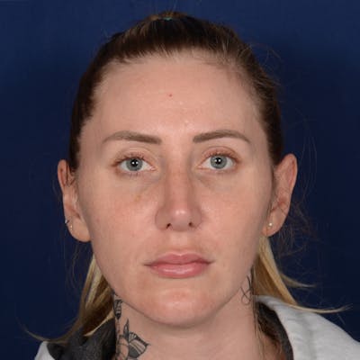 Female Rhinoplasty Before & After Gallery - Patient 198062 - Image 2