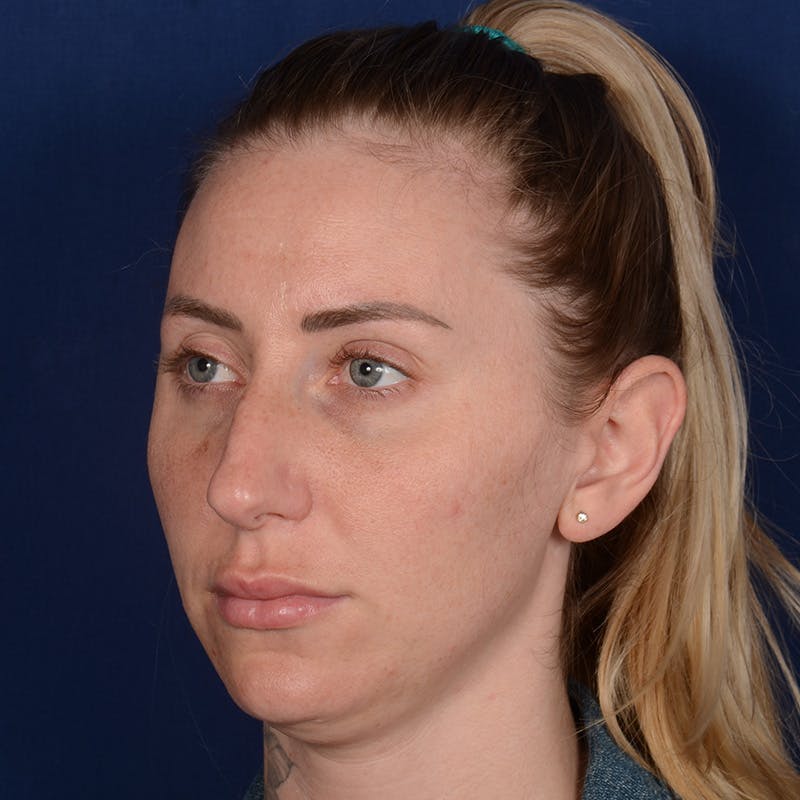 Female Rhinoplasty Before & After Gallery - Patient 198062 - Image 3