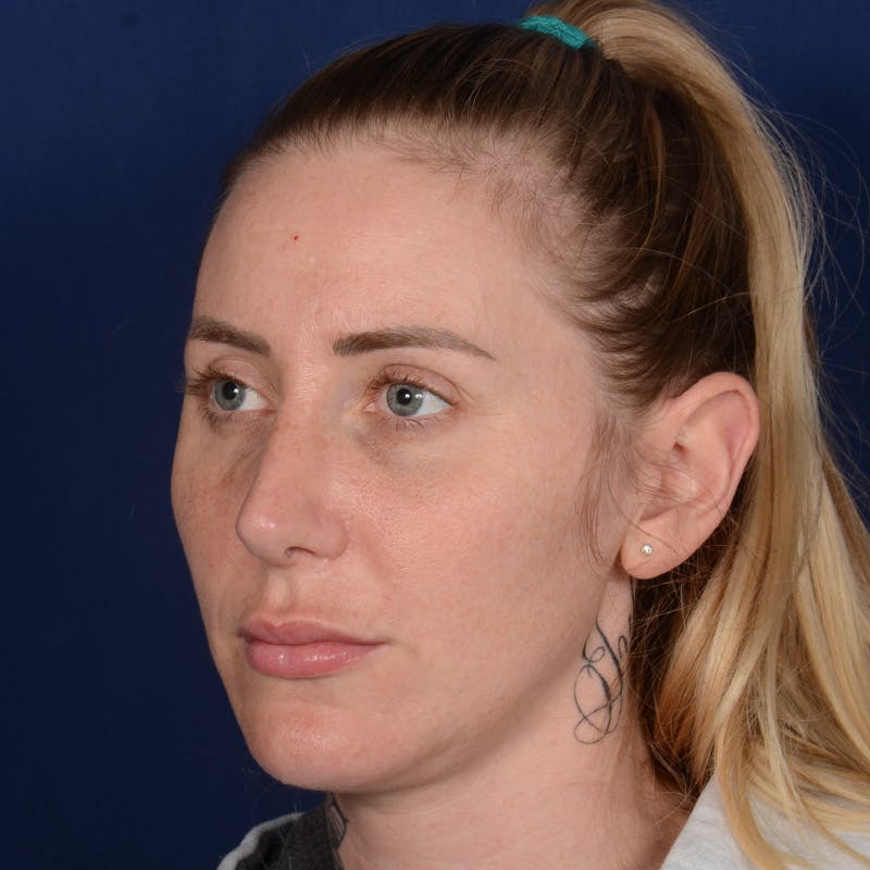 Female Rhinoplasty Before & After Gallery - Patient 198062 - Image 4
