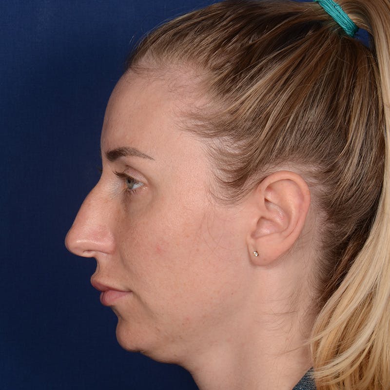 Female Rhinoplasty Before & After Gallery - Patient 198062 - Image 5