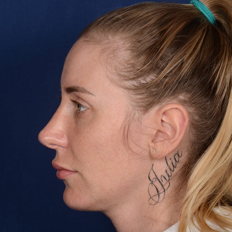 Female Rhinoplasty Before & After Gallery - Patient 198062 - Image 6