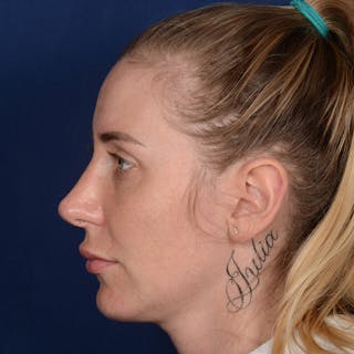 Female Rhinoplasty Before & After Gallery - Patient 198062 - Image 6