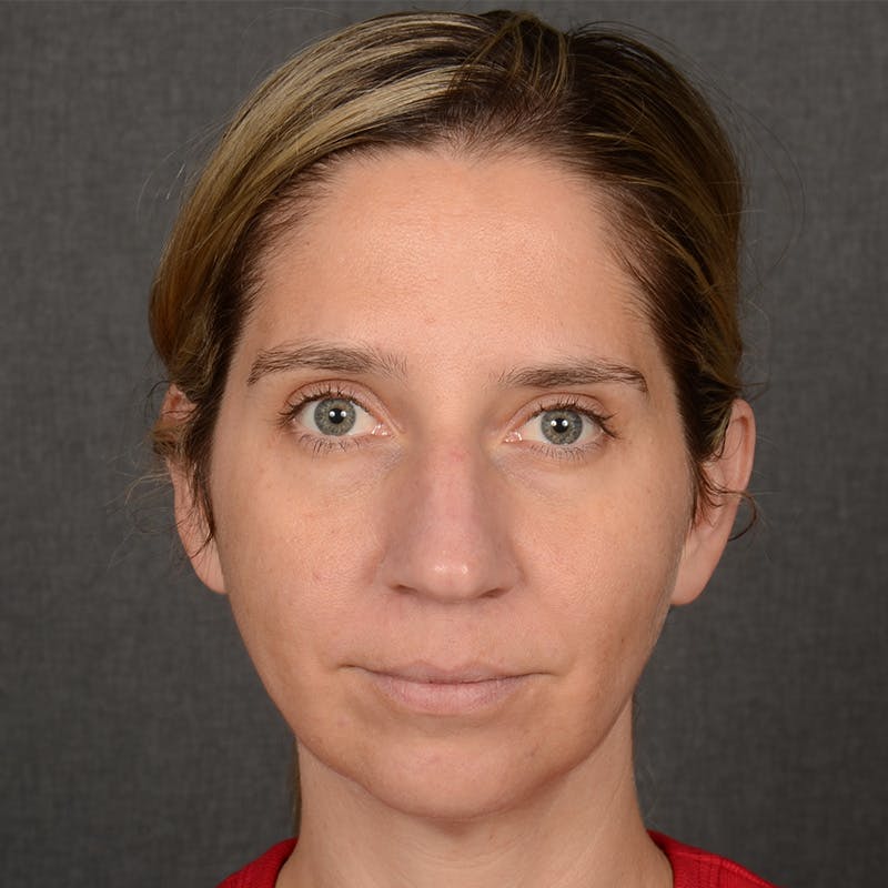 Rhinoplasty w/ Chin Implant Before & After Gallery - Patient 173270 - Image 1