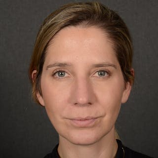 Rhinoplasty w/ Chin Implant Before & After Gallery - Patient 173270 - Image 2