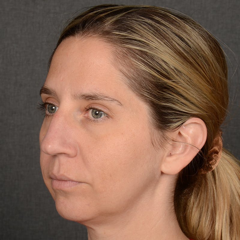 Rhinoplasty w/ Chin Implant Before & After Gallery - Patient 173270 - Image 3