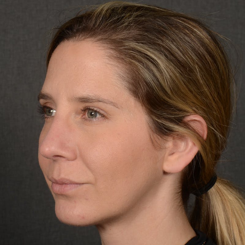 Rhinoplasty w/ Chin Implant Before & After Gallery - Patient 173270 - Image 4