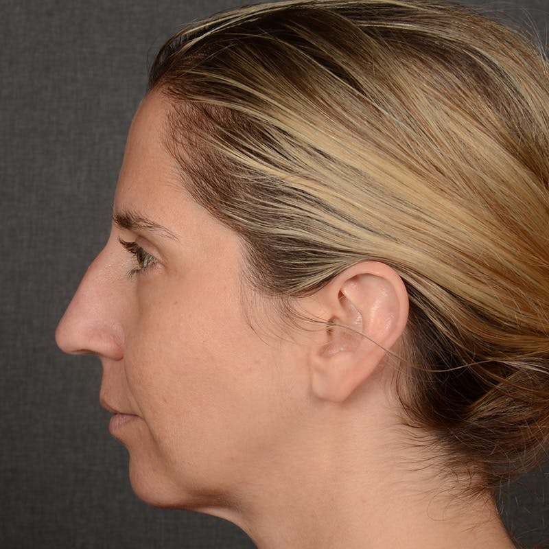 Rhinoplasty w/ Chin Implant Before & After Gallery - Patient 173270 - Image 5