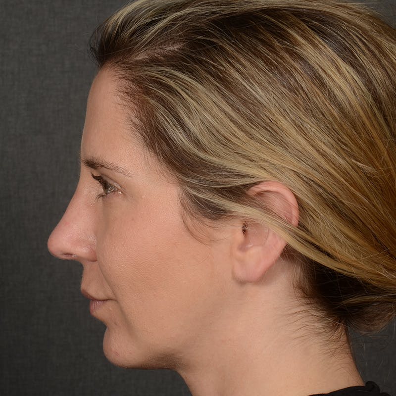 Rhinoplasty w/ Chin Implant Before & After Gallery - Patient 173270 - Image 6