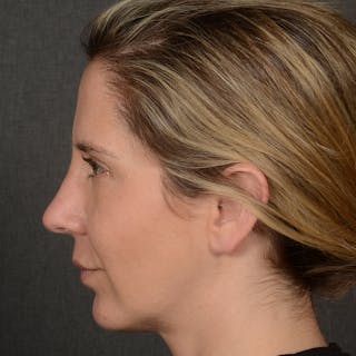 Rhinoplasty w/ Chin Implant Before & After Gallery - Patient 173270 - Image 6
