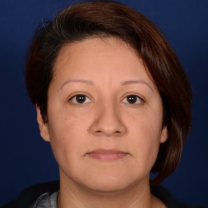 Rhinoplasty w/ Chin Implant Before & After Gallery - Patient 865672 - Image 1