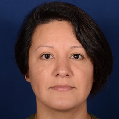 Rhinoplasty w/ Chin Implant Before & After Gallery - Patient 865672 - Image 2