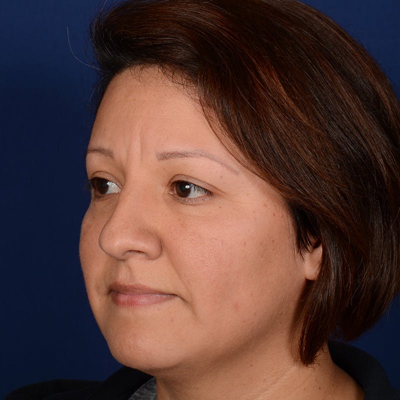 Rhinoplasty w/ Chin Implant Before & After Gallery - Patient 865672 - Image 3