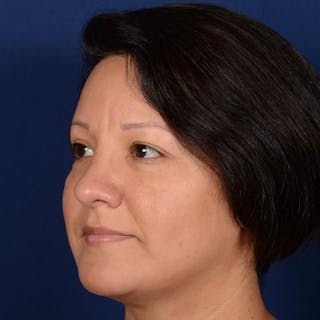Rhinoplasty w/ Chin Implant Before & After Gallery - Patient 865672 - Image 4