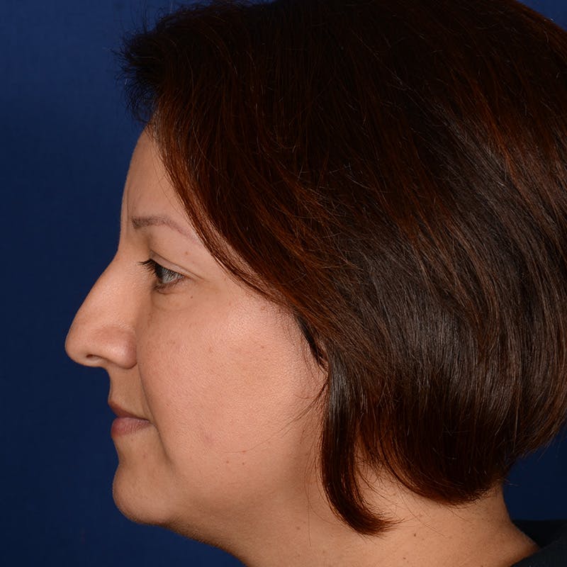 Rhinoplasty w/ Chin Implant Before & After Gallery - Patient 865672 - Image 5