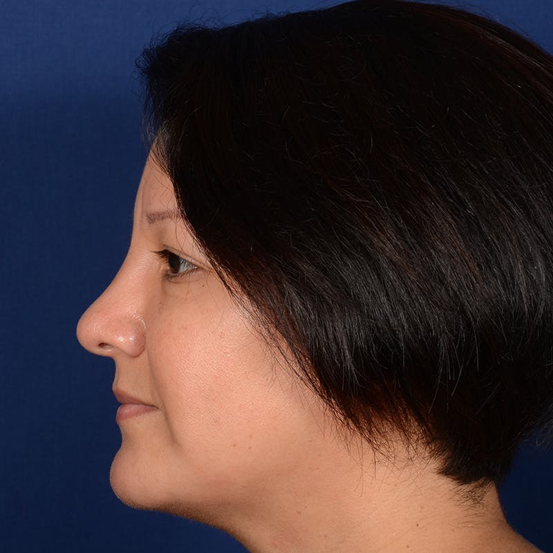 Rhinoplasty w/ Chin Implant Before & After Gallery - Patient 865672 - Image 6