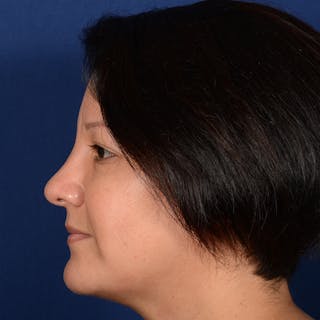 Rhinoplasty w/ Chin Implant Before & After Gallery - Patient 865672 - Image 6