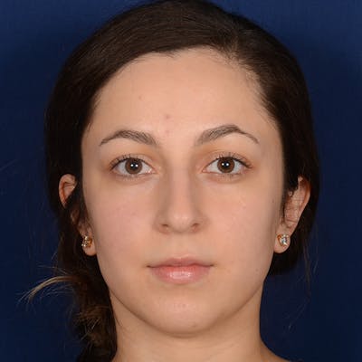 Rhinoplasty w/ Chin Implant Before & After Gallery - Patient 218211 - Image 1