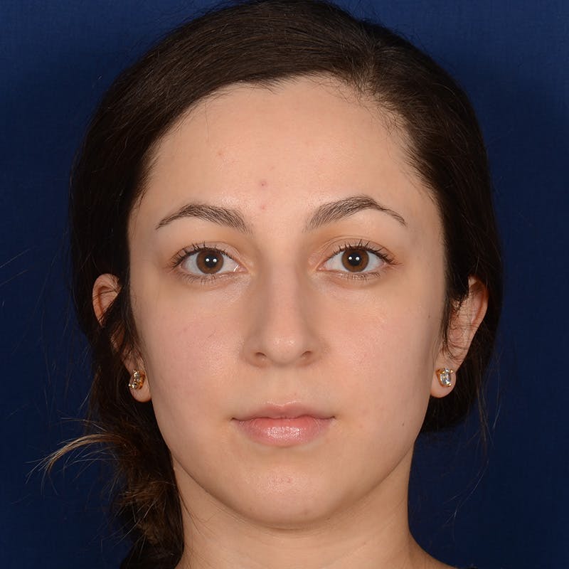 Rhinoplasty w/ Chin Implant Before & After Gallery - Patient 218211 - Image 1