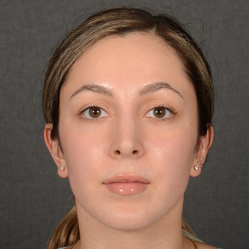 Rhinoplasty w/ Chin Implant Before & After Gallery - Patient 218211 - Image 2