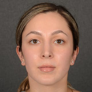 Rhinoplasty w/ Chin Implant Before & After Gallery - Patient 218211 - Image 2