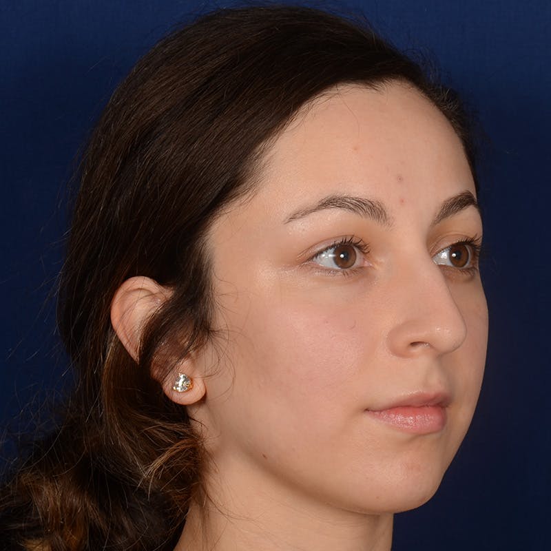 Rhinoplasty w/ Chin Implant Before & After Gallery - Patient 218211 - Image 3