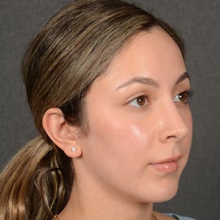 Rhinoplasty w/ Chin Implant Before & After Gallery - Patient 218211 - Image 4