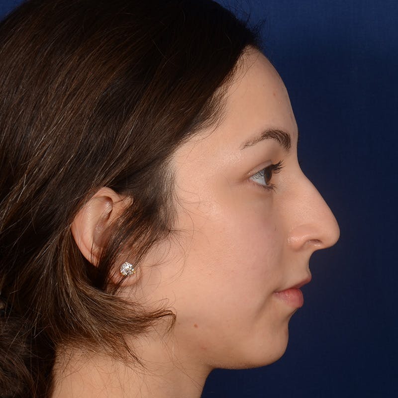 Rhinoplasty w/ Chin Implant Before & After Gallery - Patient 218211 - Image 5