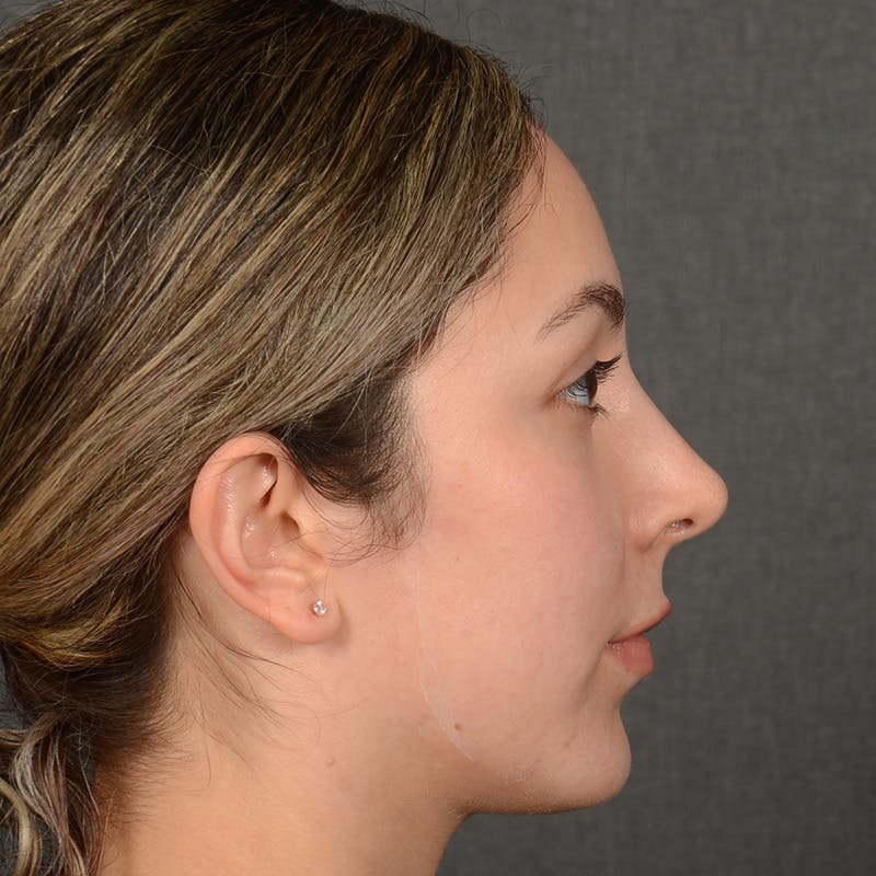 Rhinoplasty w/ Chin Implant Before & After Gallery - Patient 218211 - Image 6