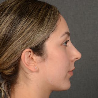 Rhinoplasty w/ Chin Implant Before & After Gallery - Patient 218211 - Image 6