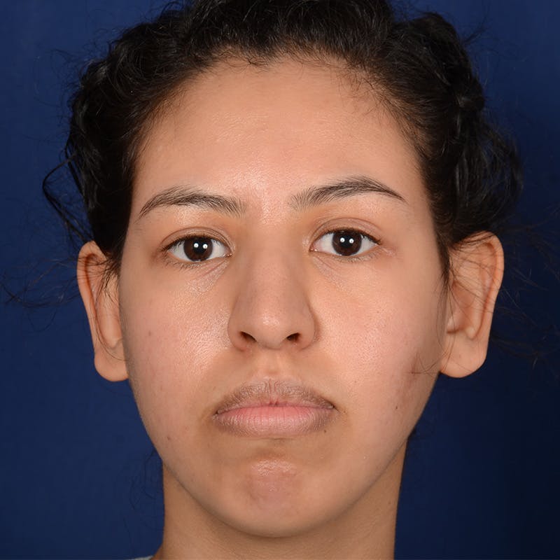 Rhinoplasty w/ Chin Implant Before & After Gallery - Patient 420886 - Image 1