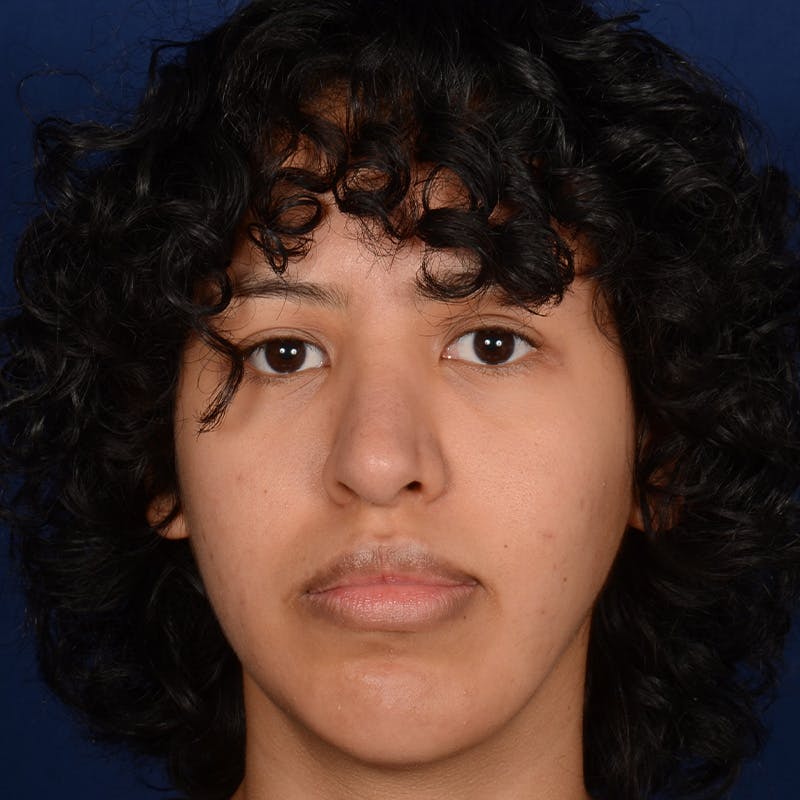 Rhinoplasty w/ Chin Implant Before & After Gallery - Patient 420886 - Image 2