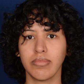 Rhinoplasty w/ Chin Implant Before & After Gallery - Patient 420886 - Image 2