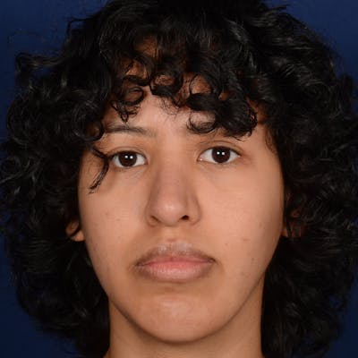 Rhinoplasty w/ Chin Implant Before & After Gallery - Patient 420886 - Image 2