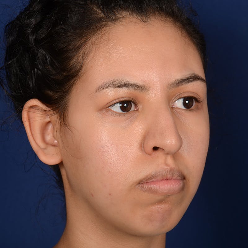 Rhinoplasty w/ Chin Implant Before & After Gallery - Patient 420886 - Image 3