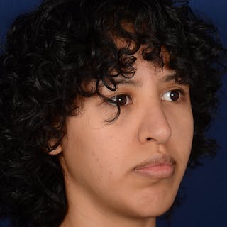 Rhinoplasty w/ Chin Implant Before & After Gallery - Patient 420886 - Image 4