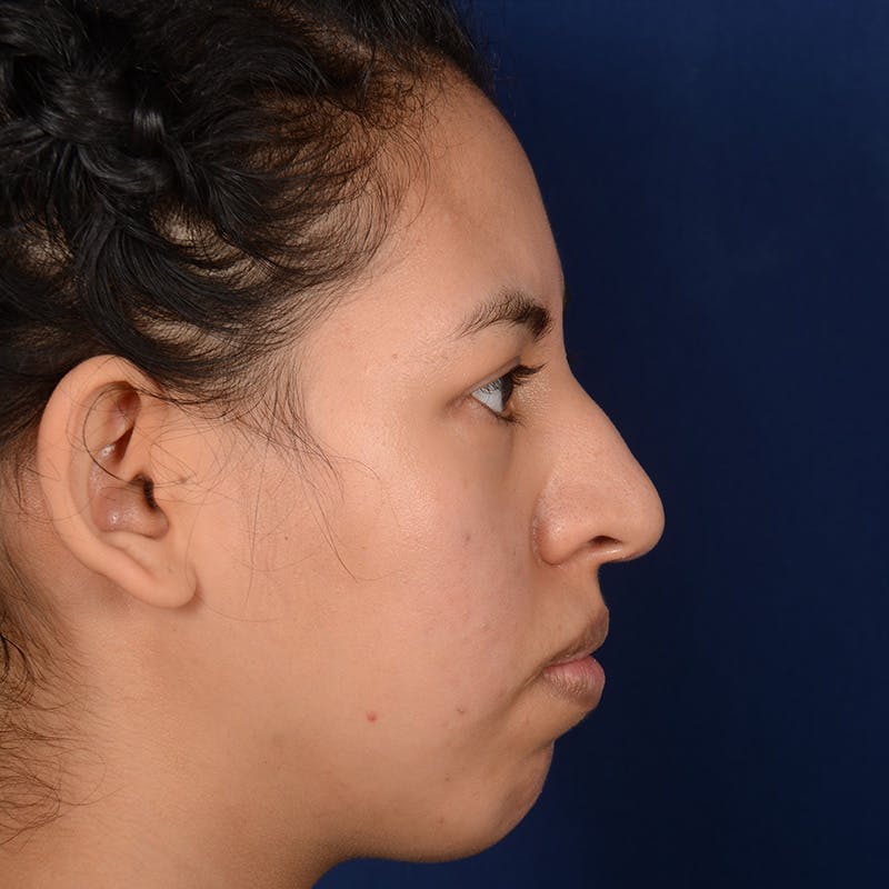 Rhinoplasty w/ Chin Implant Before & After Gallery - Patient 420886 - Image 5