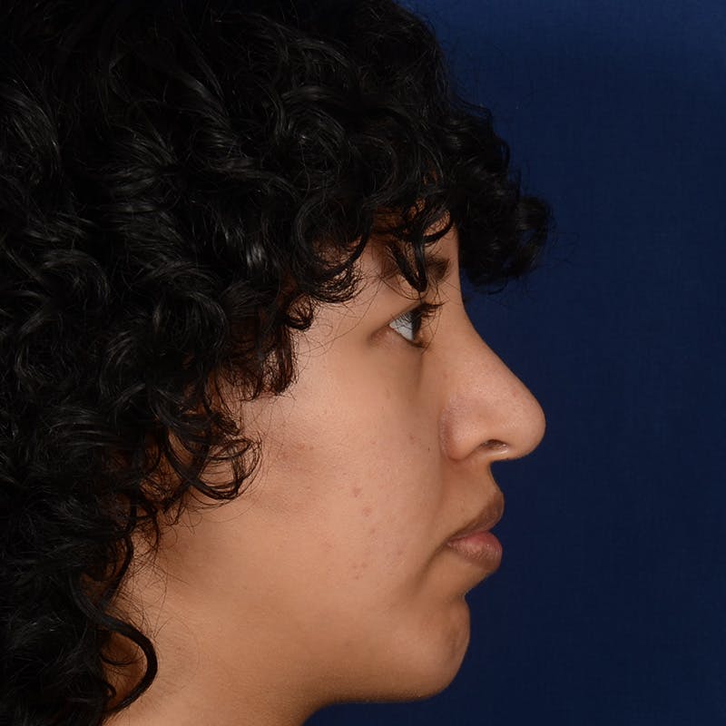 Rhinoplasty w/ Chin Implant Before & After Gallery - Patient 420886 - Image 6