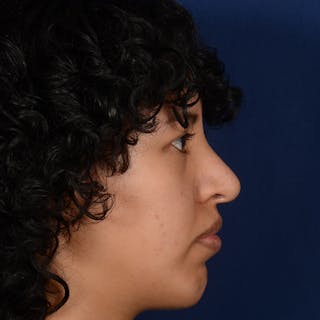 Rhinoplasty w/ Chin Implant Before & After Gallery - Patient 420886 - Image 6