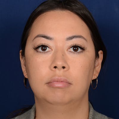 Rhinoplasty w/ Chin Implant Before & After Gallery - Patient 321116 - Image 1
