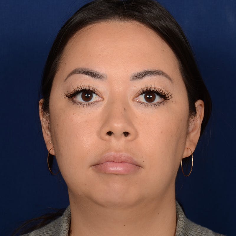 Rhinoplasty w/ Chin Implant Before & After Gallery - Patient 321116 - Image 1