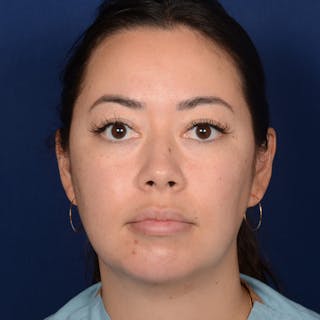 Rhinoplasty w/ Chin Implant Before & After Gallery - Patient 321116 - Image 2