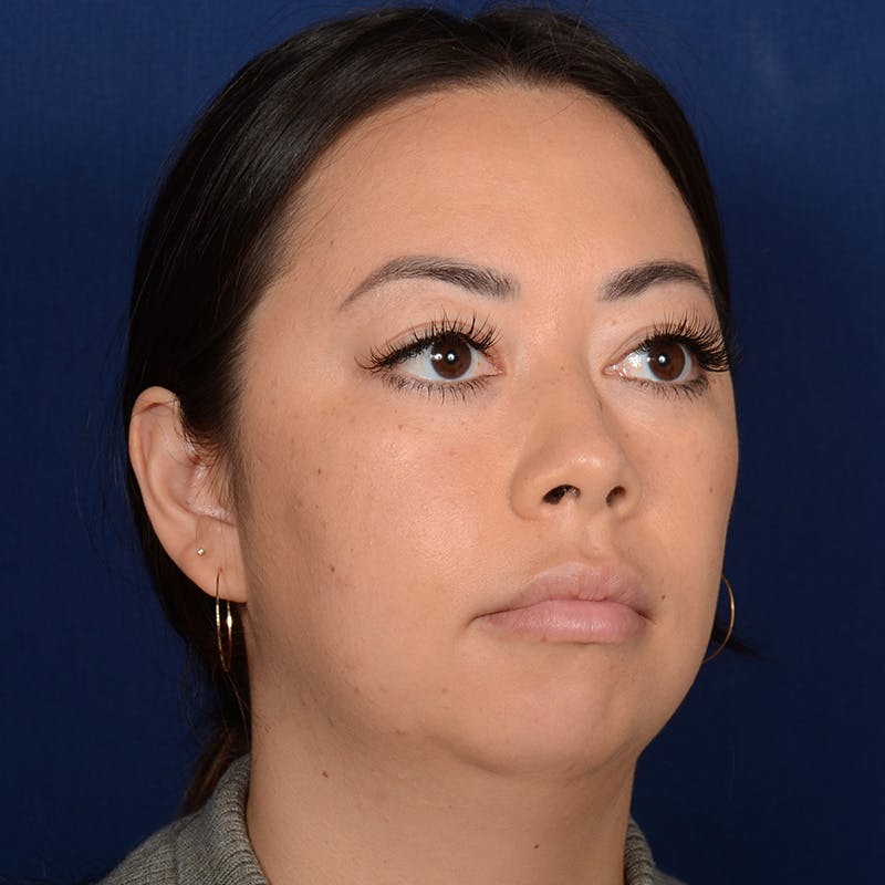 Rhinoplasty w/ Chin Implant Before & After Gallery - Patient 321116 - Image 3