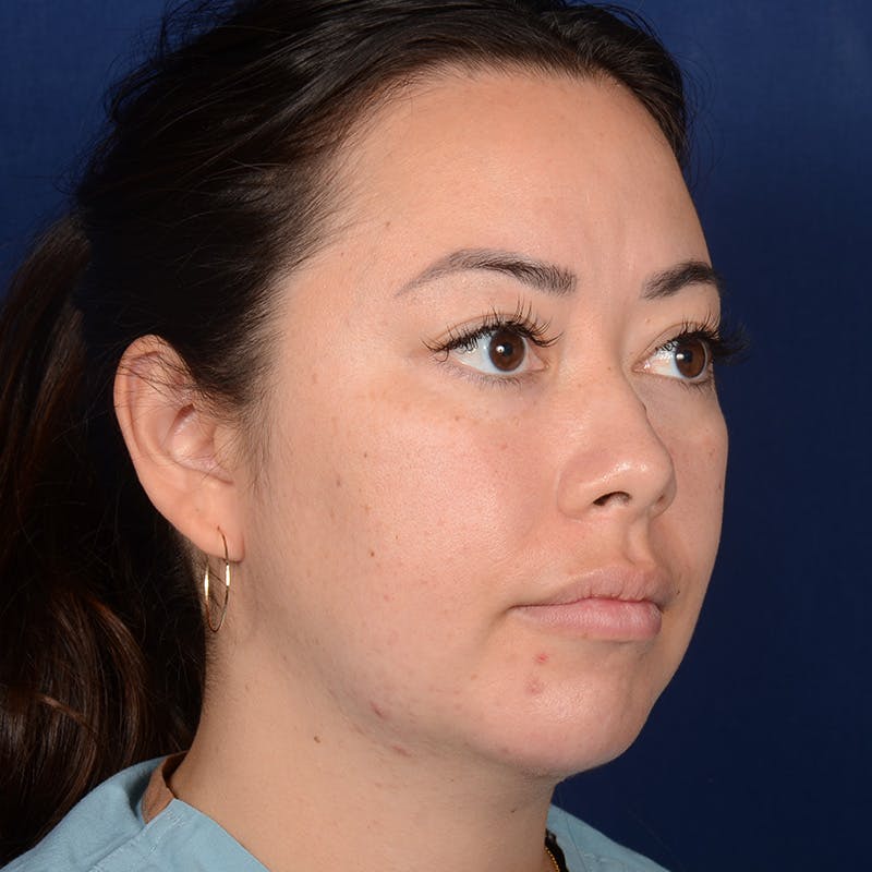 Rhinoplasty w/ Chin Implant Before & After Gallery - Patient 321116 - Image 4